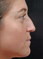 Facelift Surgery | Manhattan | New York City (NYC)