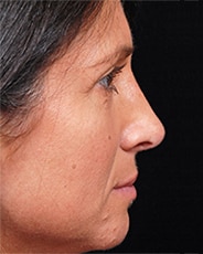 Facelift Surgery | Manhattan | New York City (NYC)