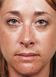 Facelift Surgery | Manhattan | New York City (NYC)