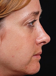 Facelift Surgery | Manhattan | New York City (NYC)