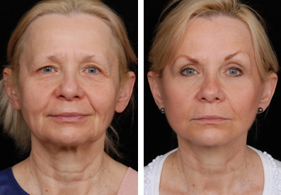 fillers vs facelifts where are the boundaries 5f7c419eedb1d