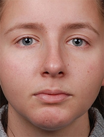 Facelift Surgery | Manhattan | New York City (NYC)