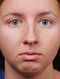 Facelift Surgery | Manhattan | New York City (NYC)