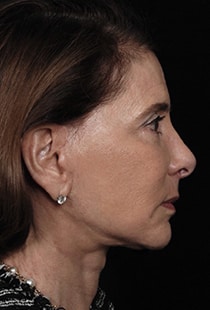 Facelift Surgery | Manhattan | New York City (NYC)