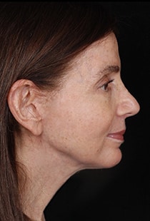 Facelift Surgery | Manhattan | New York City (NYC)