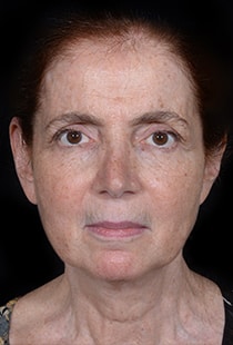 Facelift Surgery | Manhattan | New York City (NYC)