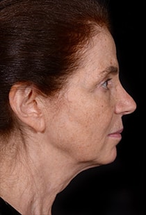 Facelift Surgery | Manhattan | New York City (NYC)