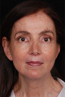 Facelift Surgery | Manhattan | New York City (NYC)