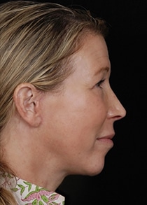 Facelift Surgery | Manhattan | New York City (NYC)