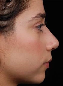 Rhinoplasty Surgery | Manhattan | New York City (NYC)