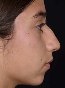 Rhinoplasty Surgery | Manhattan | New York City (NYC)