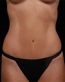 Abdominoplasty | Manhattan | New York City (NYC)