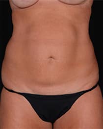 Abdominoplasty | Manhattan | New York City (NYC)