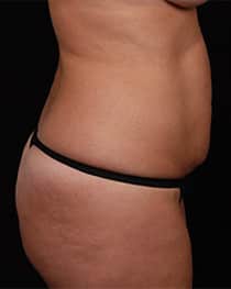 Abdominoplasty | Manhattan | New York City (NYC)