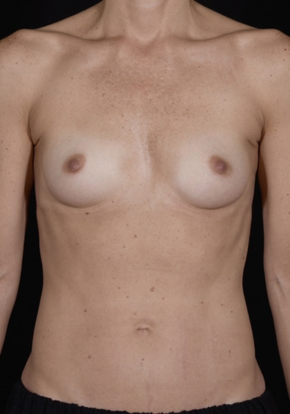 Breast Augmentation | Manhattan | New York City (NYC)