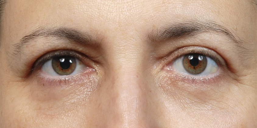 Facelift Surgery | Manhattan | New York City (NYC)