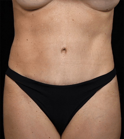 Abdominoplasty | Manhattan | New York City (NYC)