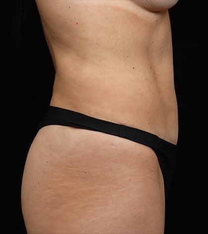 Abdominoplasty | Manhattan | New York City (NYC)