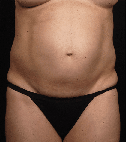 Facelift Surgery | Manhattan | New York City (NYC)