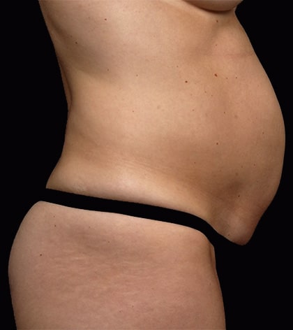 Facelift Surgery | Manhattan | New York City (NYC)