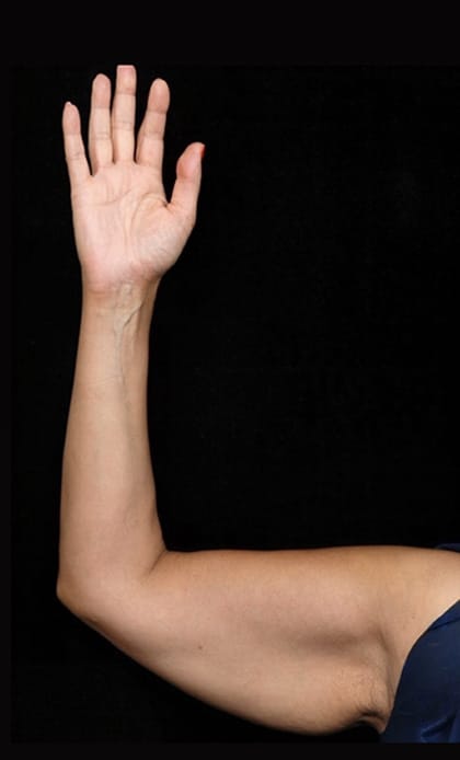 Arms Surgery | Manhattan | New York City (NYC)