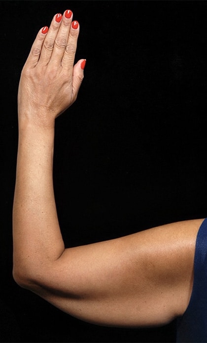 Arms Surgery | Manhattan | New York City (NYC)