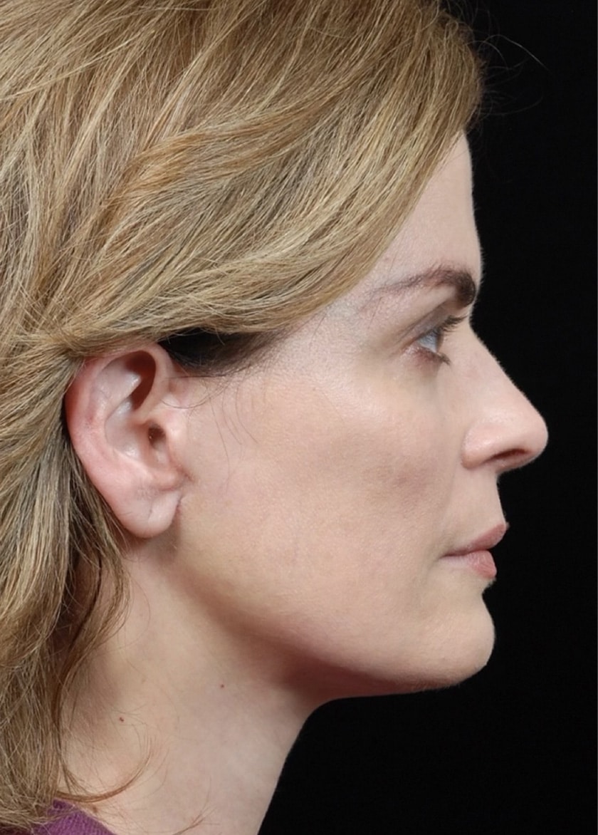 Facelift Surgery | Manhattan | New York City (NYC)