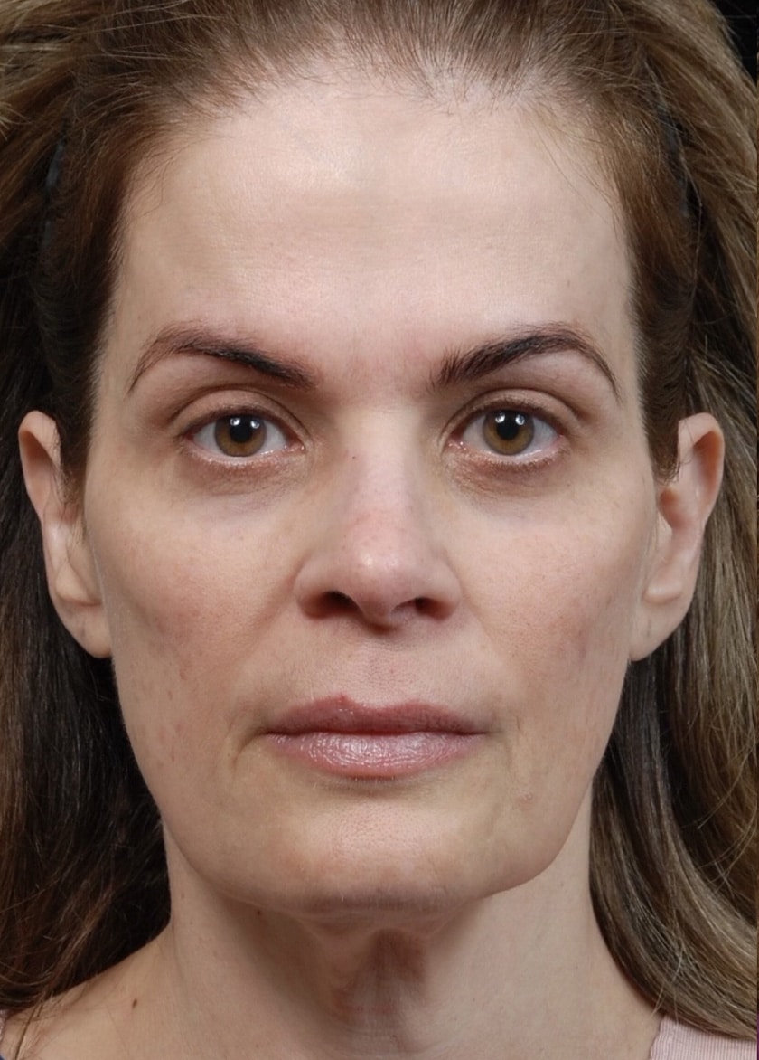 Facelift Surgery | Manhattan | New York City (NYC)