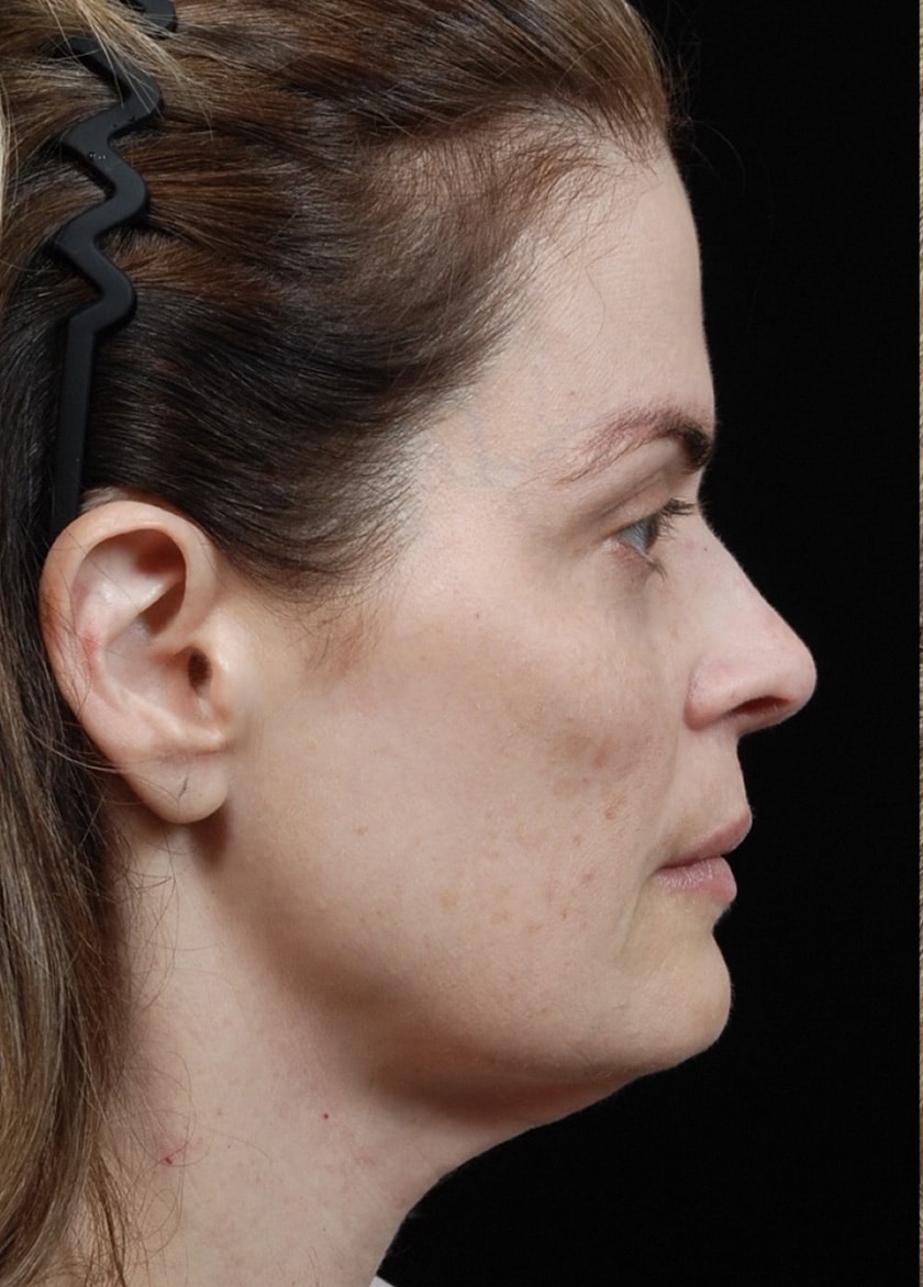 Facelift Surgery | Manhattan | New York City (NYC)