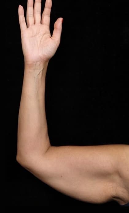 Arms Surgery | Manhattan | New York City (NYC)