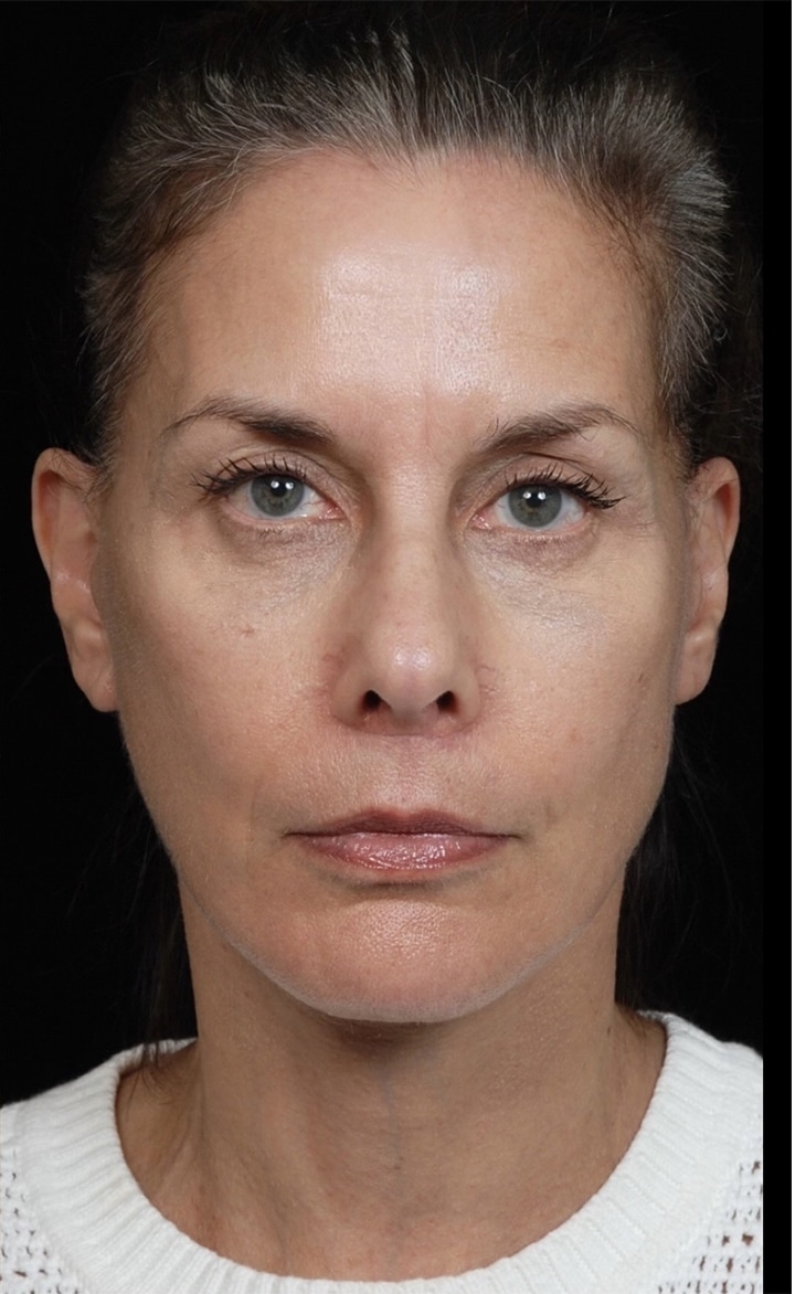 Facelift Surgery | Manhattan | New York City (NYC)