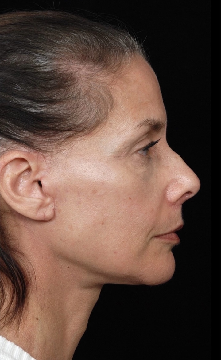 Facelift Surgery | Manhattan | New York City (NYC)