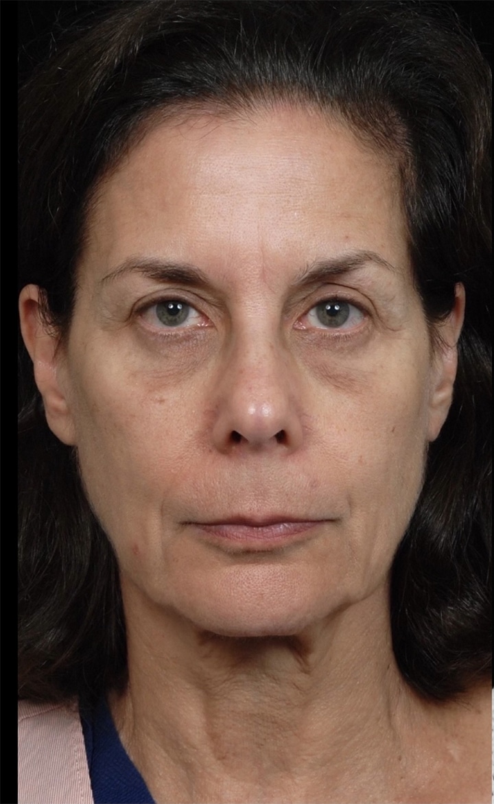 Facelift Surgery | Manhattan | New York City (NYC)