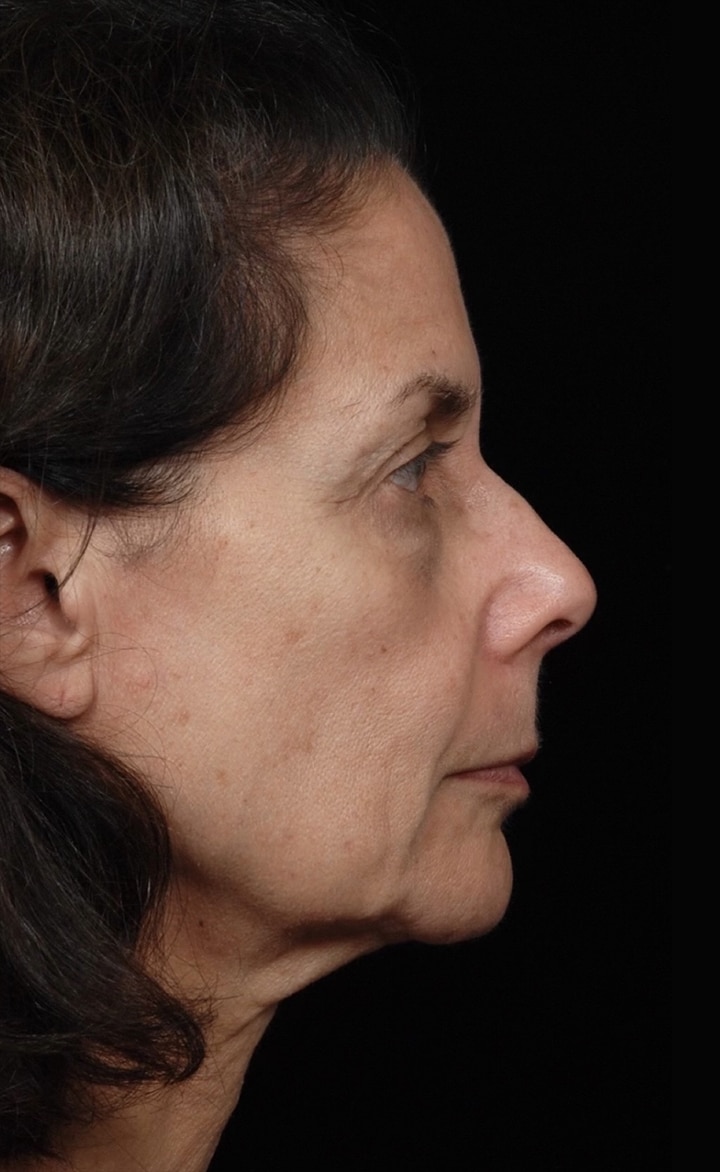 Facelift Surgery | Manhattan | New York City (NYC)