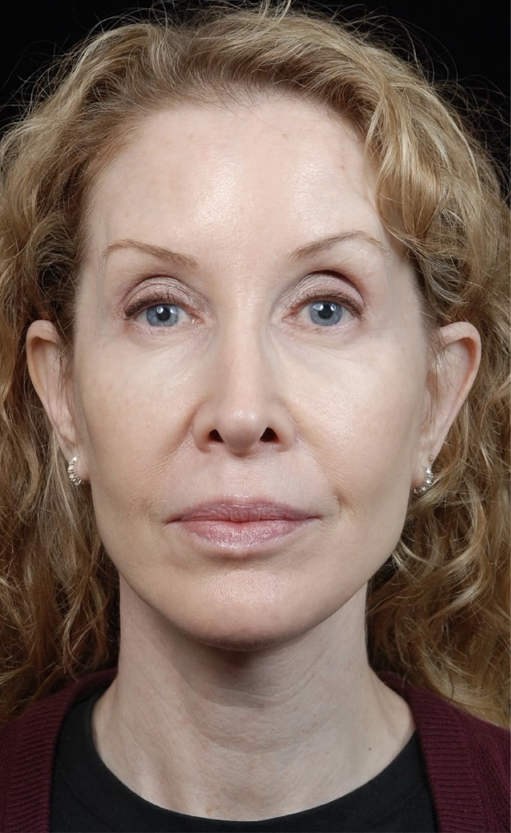 Facelift Surgery | Manhattan | New York City (NYC)