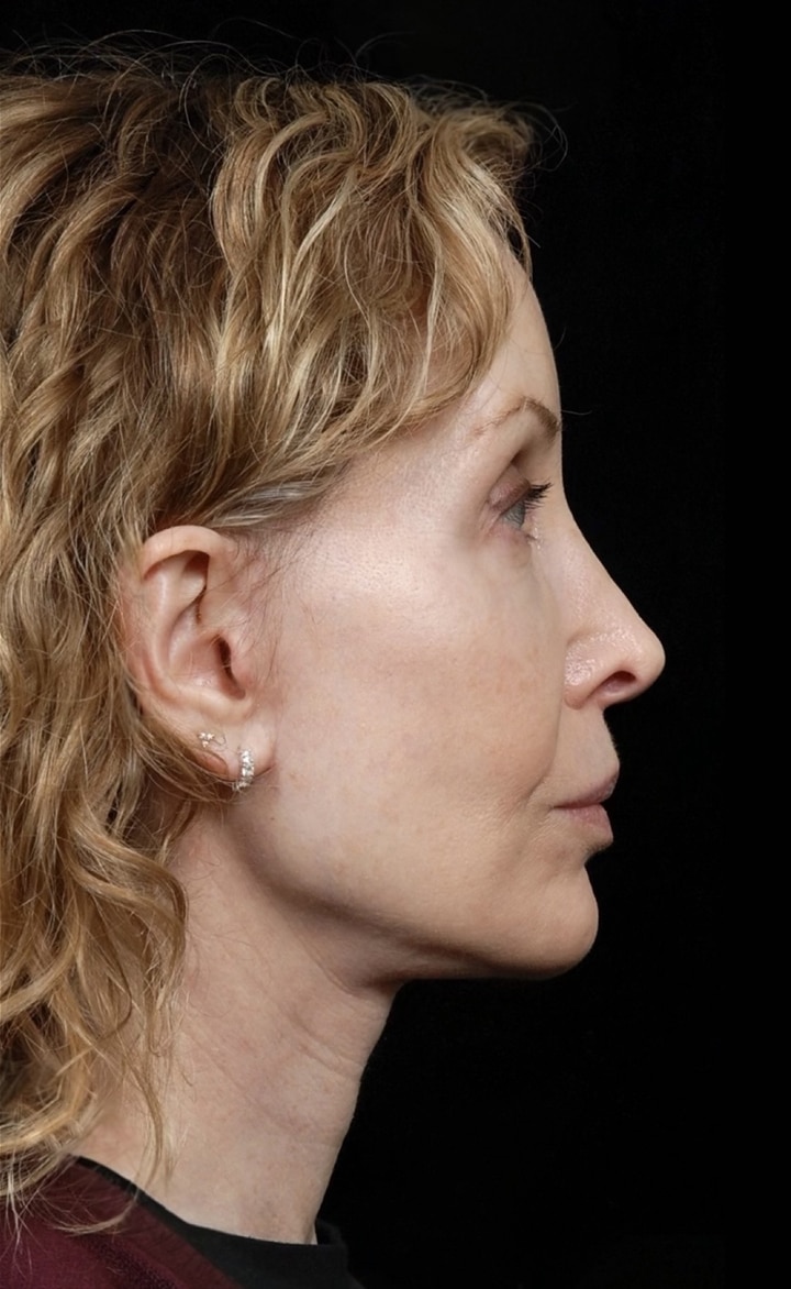 Facelift Surgery | Manhattan | New York City (NYC)
