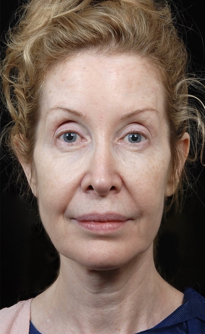 Facelift Surgery | Manhattan | New York City (NYC)