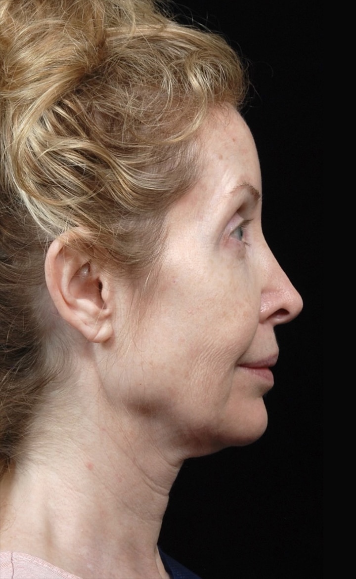 Facelift Surgery | Manhattan | New York City (NYC)