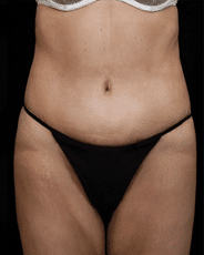 Abdominoplasty | Manhattan | New York City (NYC)