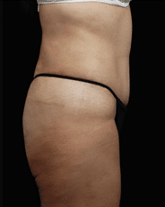 Abdominoplasty | Manhattan | New York City (NYC)