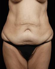 Abdominoplasty | Manhattan | New York City (NYC)