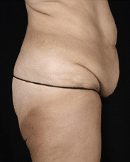 Abdominoplasty | Manhattan | New York City (NYC)