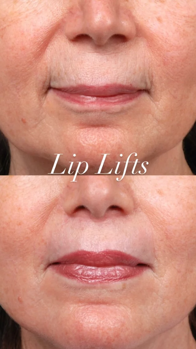 The effect of lip lifts should be subtle and elegant. Its best indications are women over fifty who have associated aging changes. They generally should be avoided in younger patients. The result cannot be reversed if overdone!

#lip #lift #face