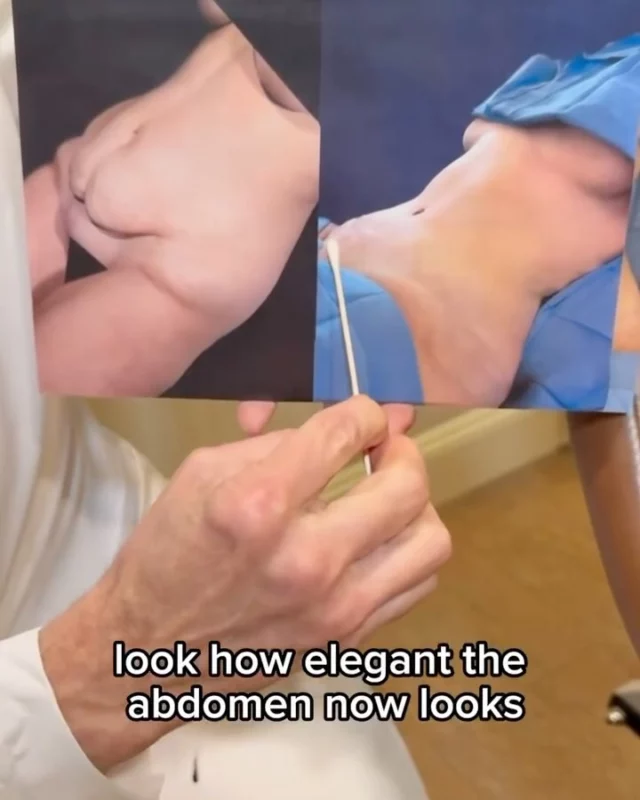 Massive weight loss resulting from new drug therapies can result in major skin laxity involving the abdomen and breasts. More extreme cases also affect the upper arms, thighs, and buttocks. Surgery can trade scars for tight skin in all of these areas. It’s a big commitment but helps complete the journey. 

#weight #skin #surgery #scars