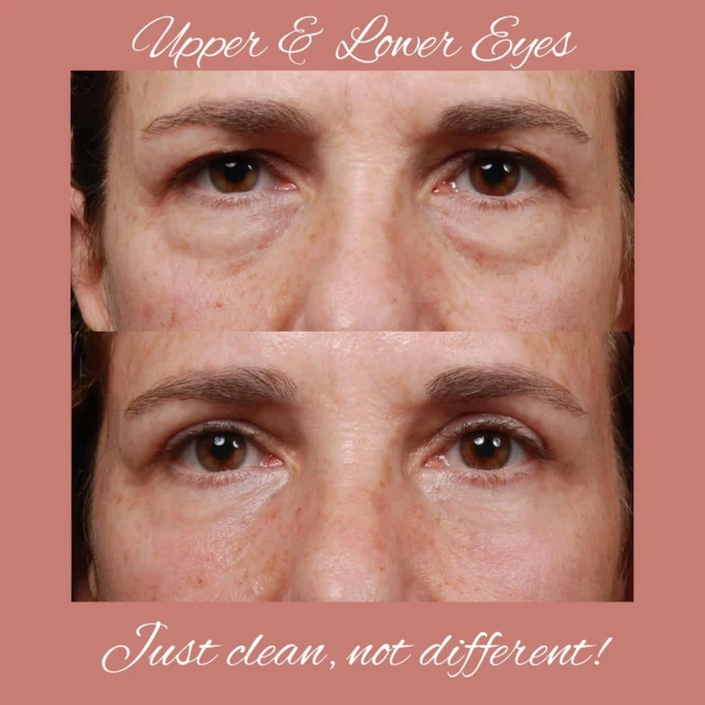 There is a movement afoot within parts of the specialty to create a unique and customized look that is hardly natural. Such concepts are ill conceived. Anyone who might want to look like the patient in the second image is making a permanent decision, much like modern body ink. The physician’s Hippocratic oath begins: First, do no harm…

#eyes #natural #look