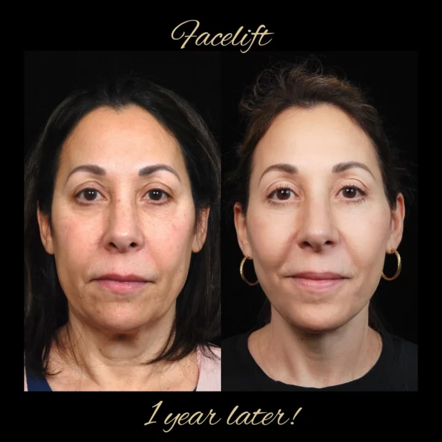 We try not to have our patients smile on the postoperative views for consistency but they are just happier!
 
Thank you to our patient for allowing us to share. 

#face #happy #lift