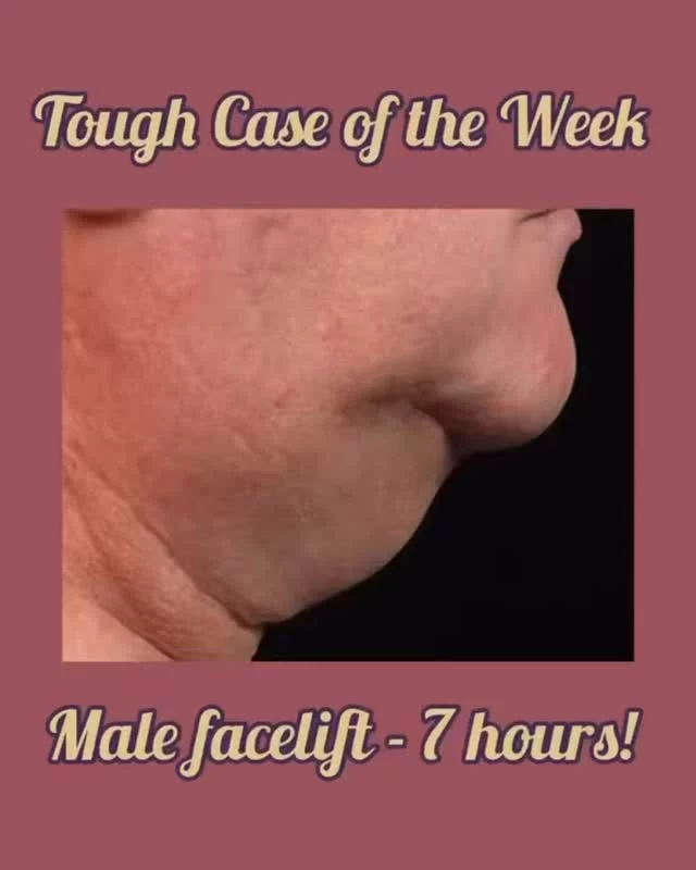 Male facelifts are challenging because men’s heads are bigger and the blood supply much more vigorous compared to women. Although the surgical concepts and anatomy are the same, it just takes longer to do. The good news is that life changing transformations can be achieved!

#face #men #look