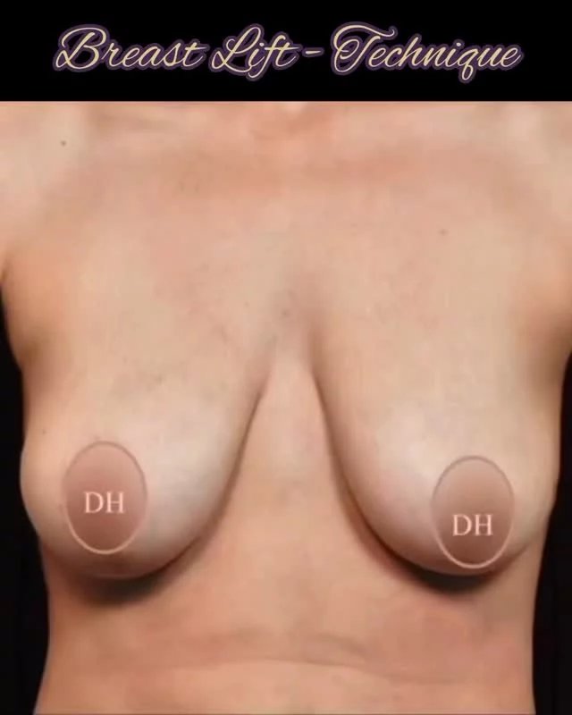Breast “lifts” are a misnomer. The breasts are actually pushed up from the bottom instead, thereby concealing the scars. The technique involves removing skin from within the design triangle shown to achieve the “lift”. Here are key truths about procedure limitations:

 1. The breasts will never go as high as desired despite a maximum effort.

2. There will always be a small amount of residual overhang at the bottom, I.e. failing the “ pencil test”.

3. Breasts that are positioned low on the chest but do not droop are not suitable for breast lift procedures. 

4. Eventually the skin will stretch again and the condition may recur to some degree. The good news here is that the procedure could be repeated without adding new scars. 

Despite all of this major transformations are possible! 

#lift #higher #shape